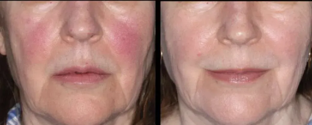 A before and after photo of a woman 's face