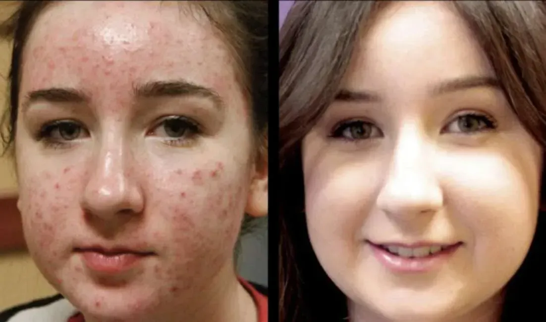 A before and after photo of a woman 's face with acne