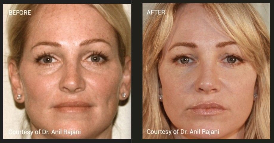 A before and after photo of a woman 's face