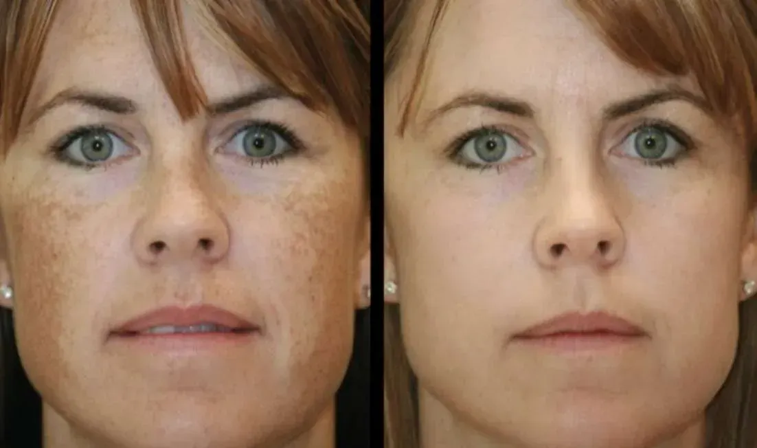 A before and after photo of a woman 's face.
