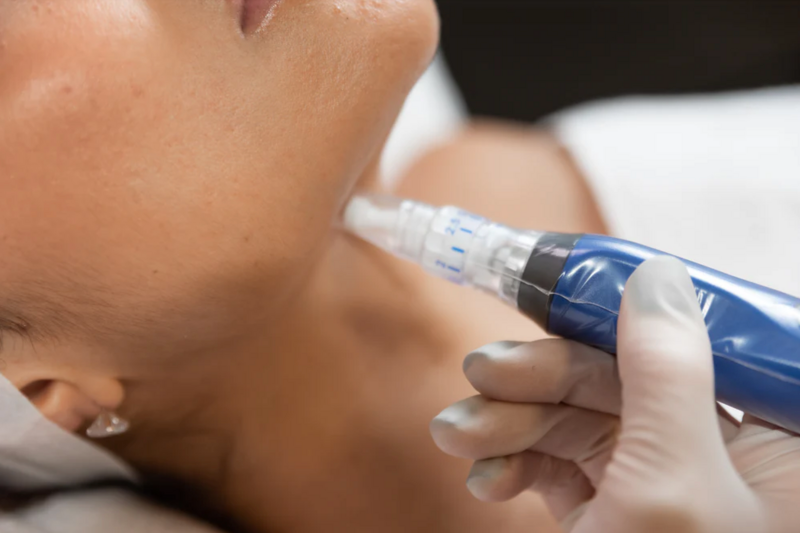 A woman is getting a microneedle treatment on her neck.