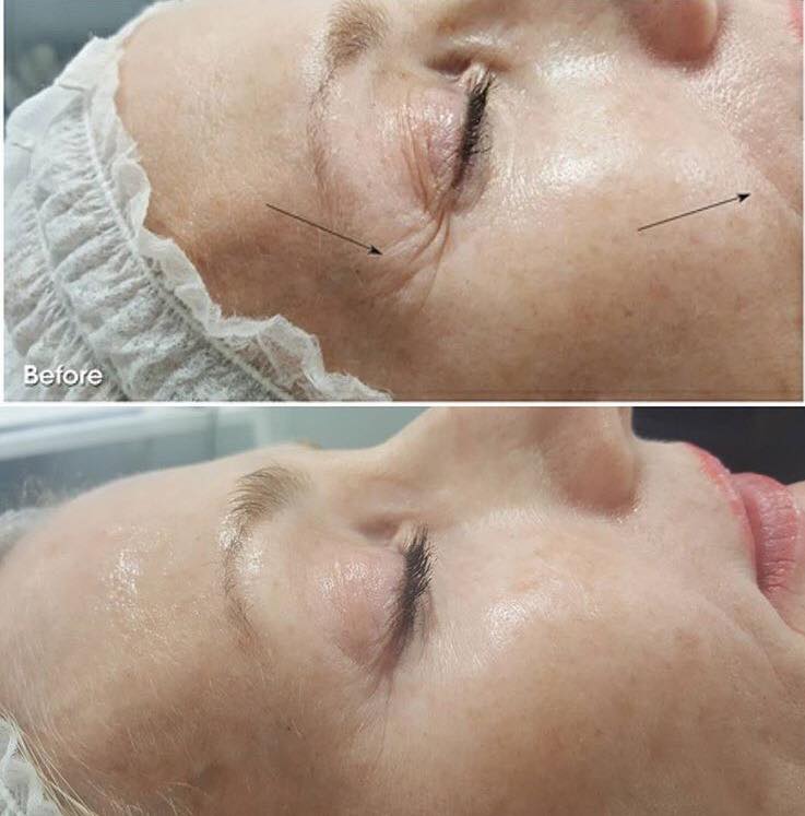 natuurlijke facelift goirle