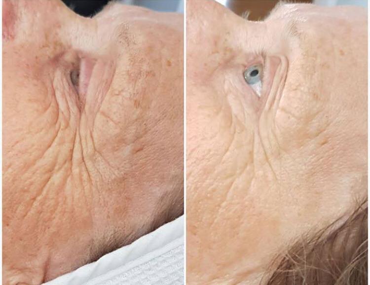 natuurlijke facelift zonder botox goirle