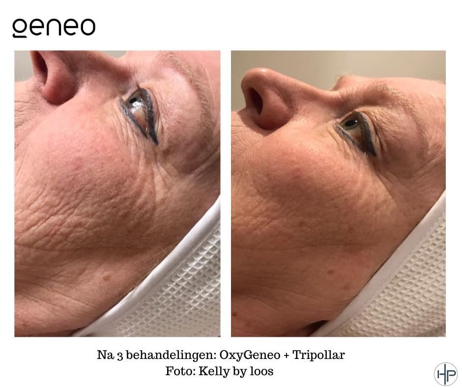 rimpels verminderen goirle
