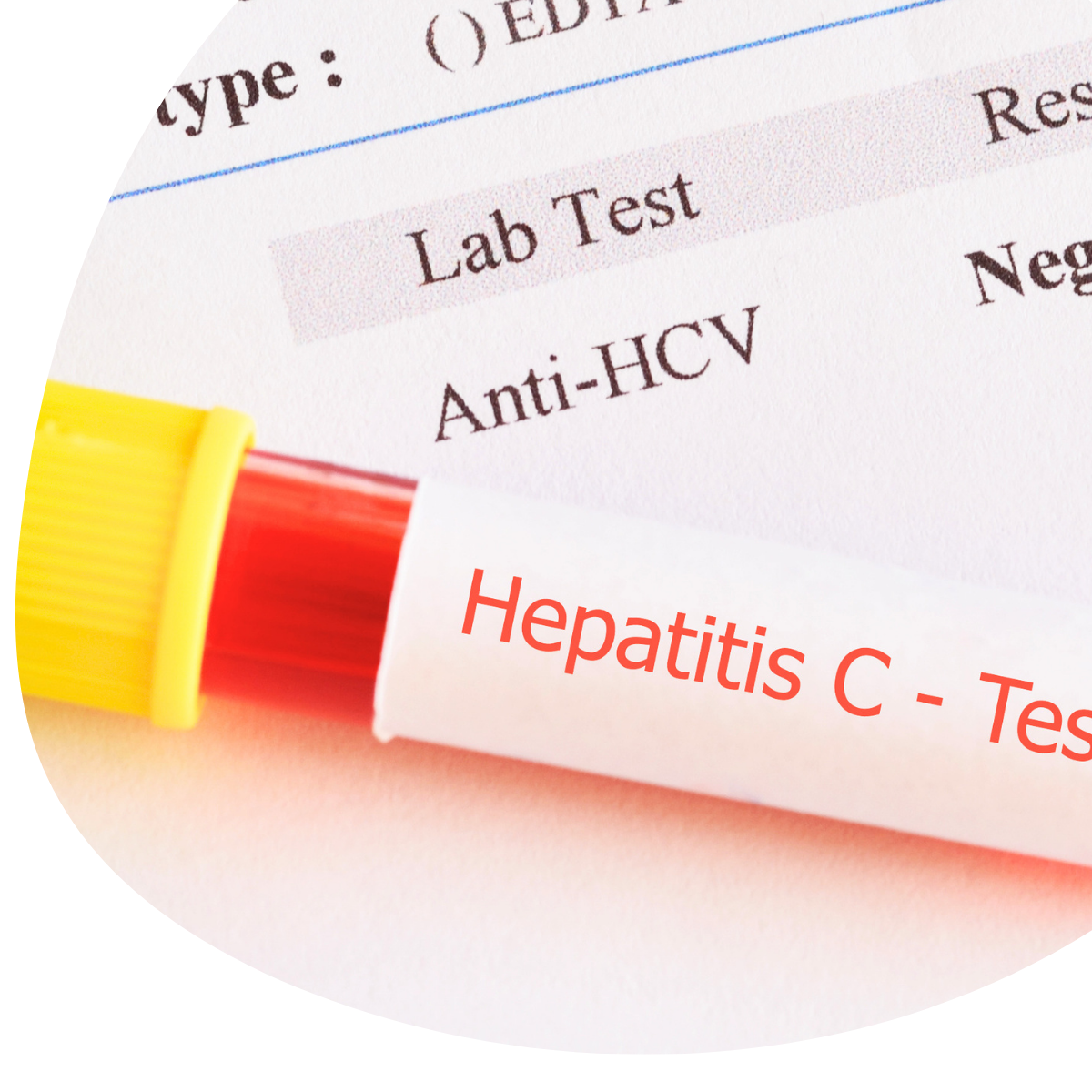Hepatitis C test tube and lab report showing Anti-HCV result.