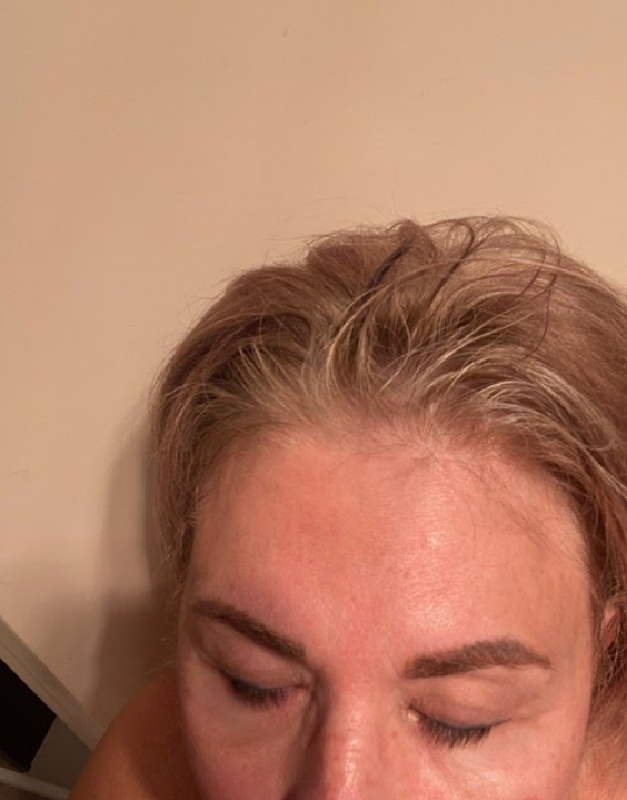Gloved hands applying a small medical treatment to skin with a white applicator