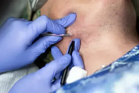 Gloved practitioner using a pen tool to treat facial skin blemishes on a man’s cheek