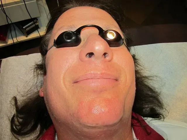 Gloved hands perform a close-up cosmetic needle treatment on a man's chin and beard area