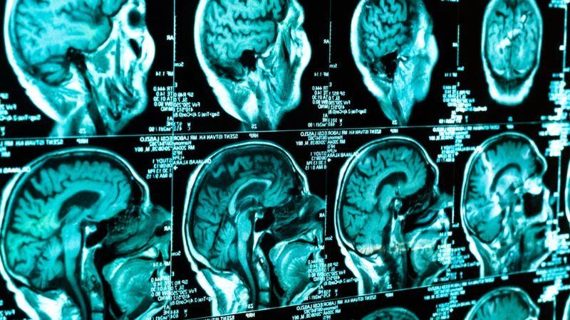 A mri scan of a person 's brain showing different sections of the brain.