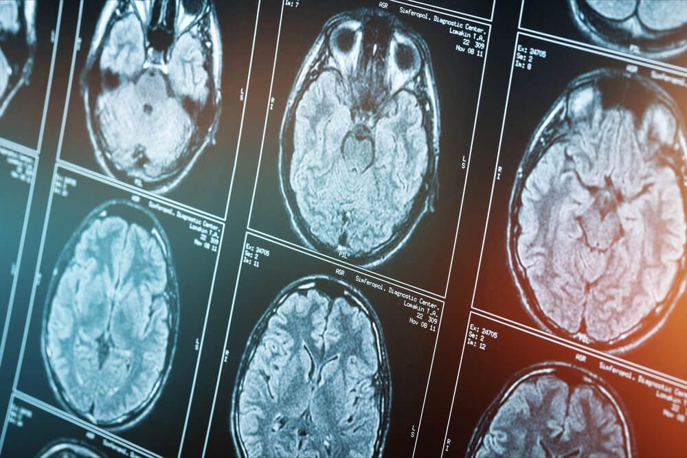 Knowing the symptoms of serious head injury are important when it comes to second impact syndrome.