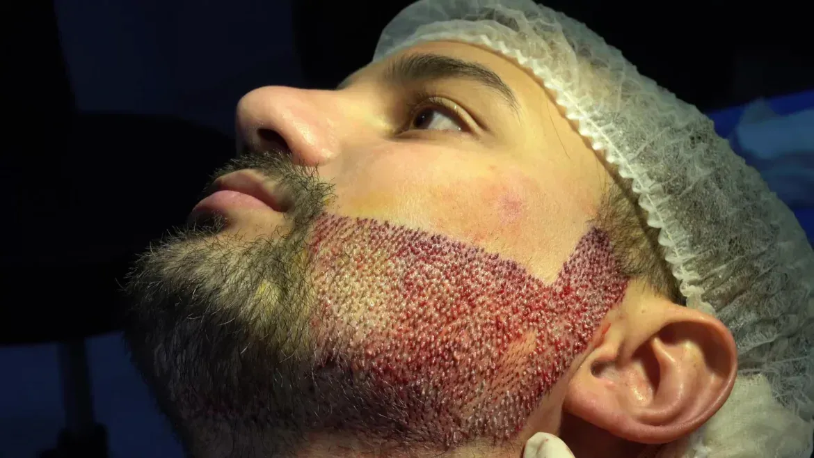 A person’s profile view showing a freshly performed beard hair transplant procedure with visible redness and stubble.