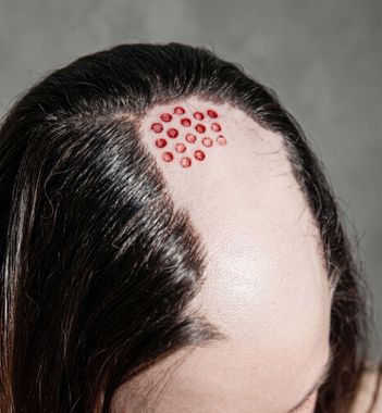 Close-up of a scalp with a cluster of red circular marks near the hairline