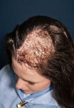 Close-up of a scalp with hair loss and scaly, irritated skin under dark hair.