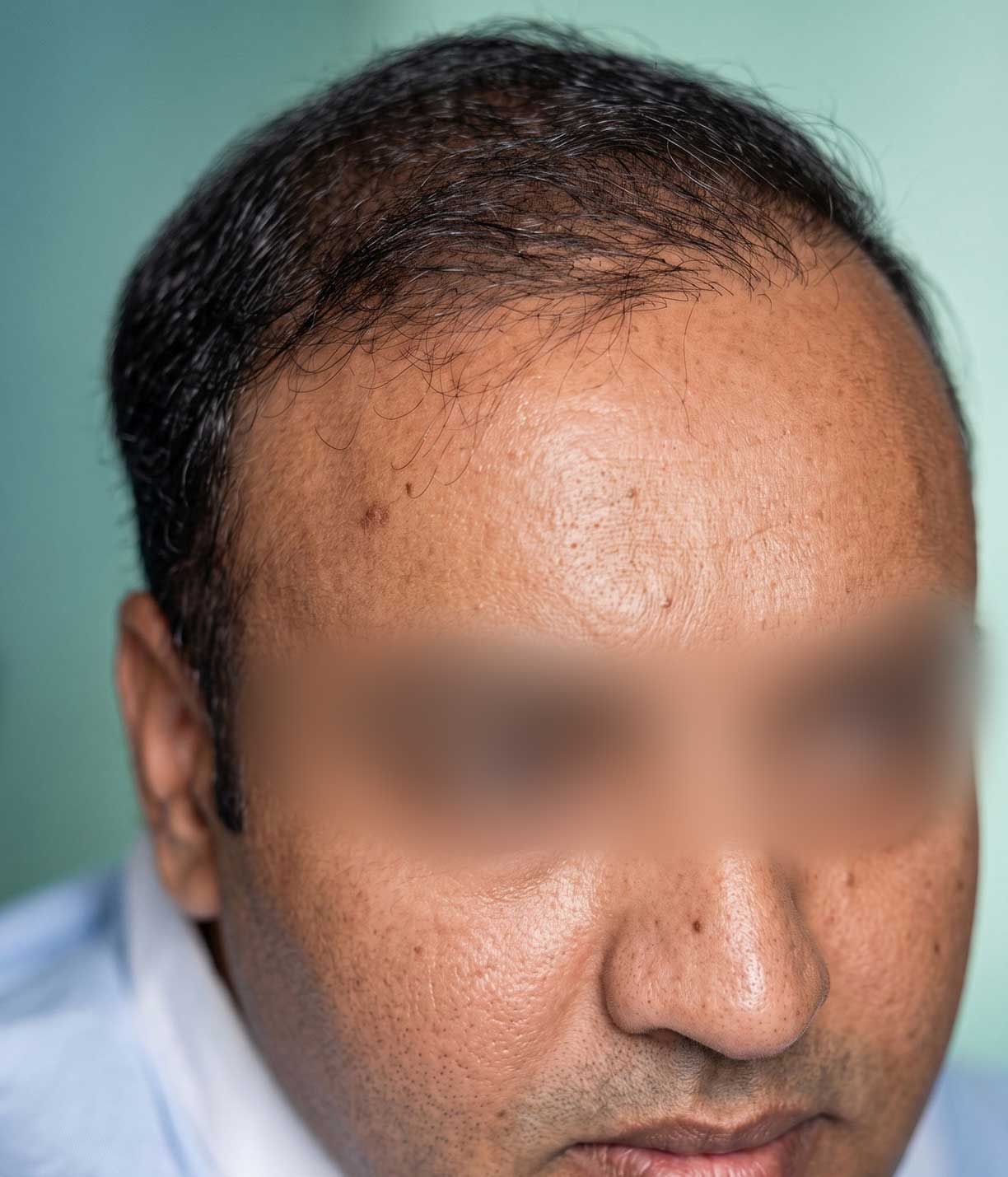 Close-up of a man’s face with blurred eyes, showing thinning hair and a receding hairline.