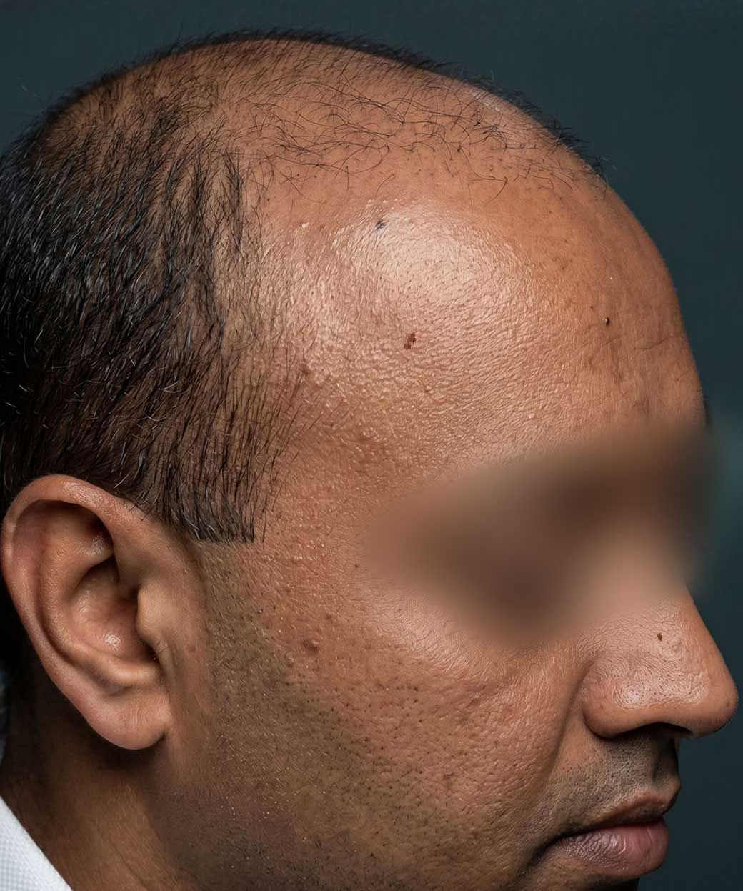 Side-profile portrait of a balding man against a dark background