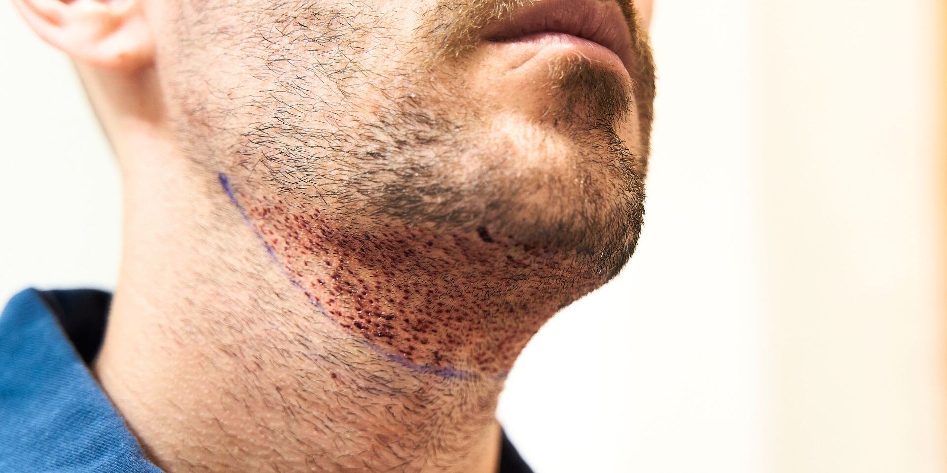 A person's chin and neck area with small, red puncture marks following a beard hair transplant procedure.
