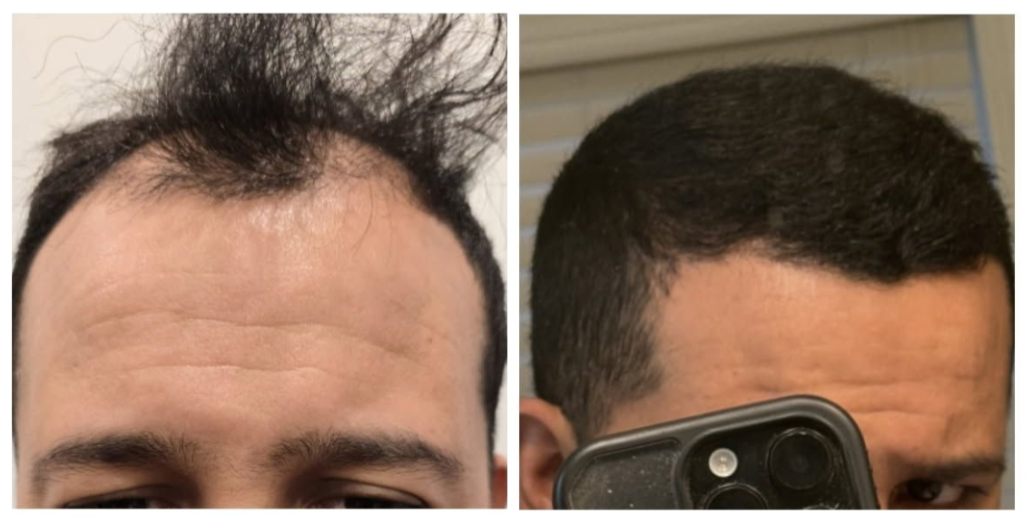 A four-panel progression showing hair transplant results, from initial thinning and post-op to fully grown-in hair.