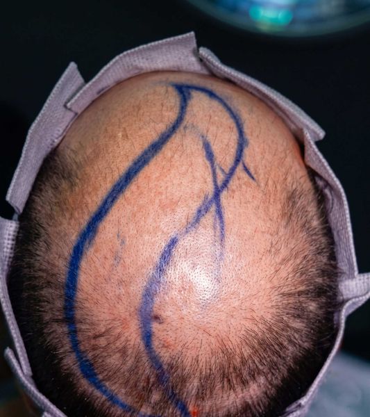 Top view of a shaved scalp with blue surgical marker lines and a gauze headband