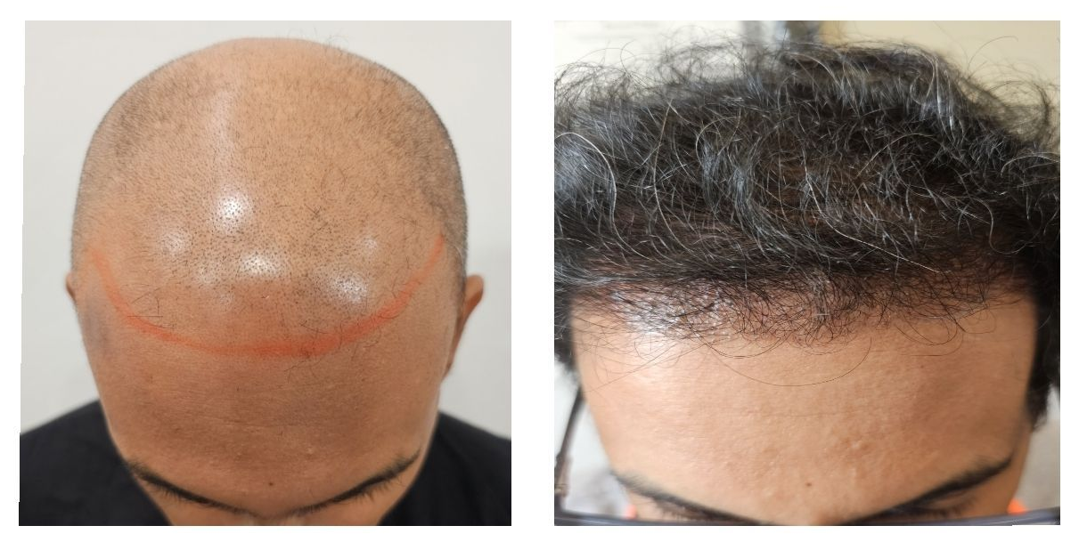 Before and after hair transplant comparison showing frontal and top-down views of a scalp with restored hair density.