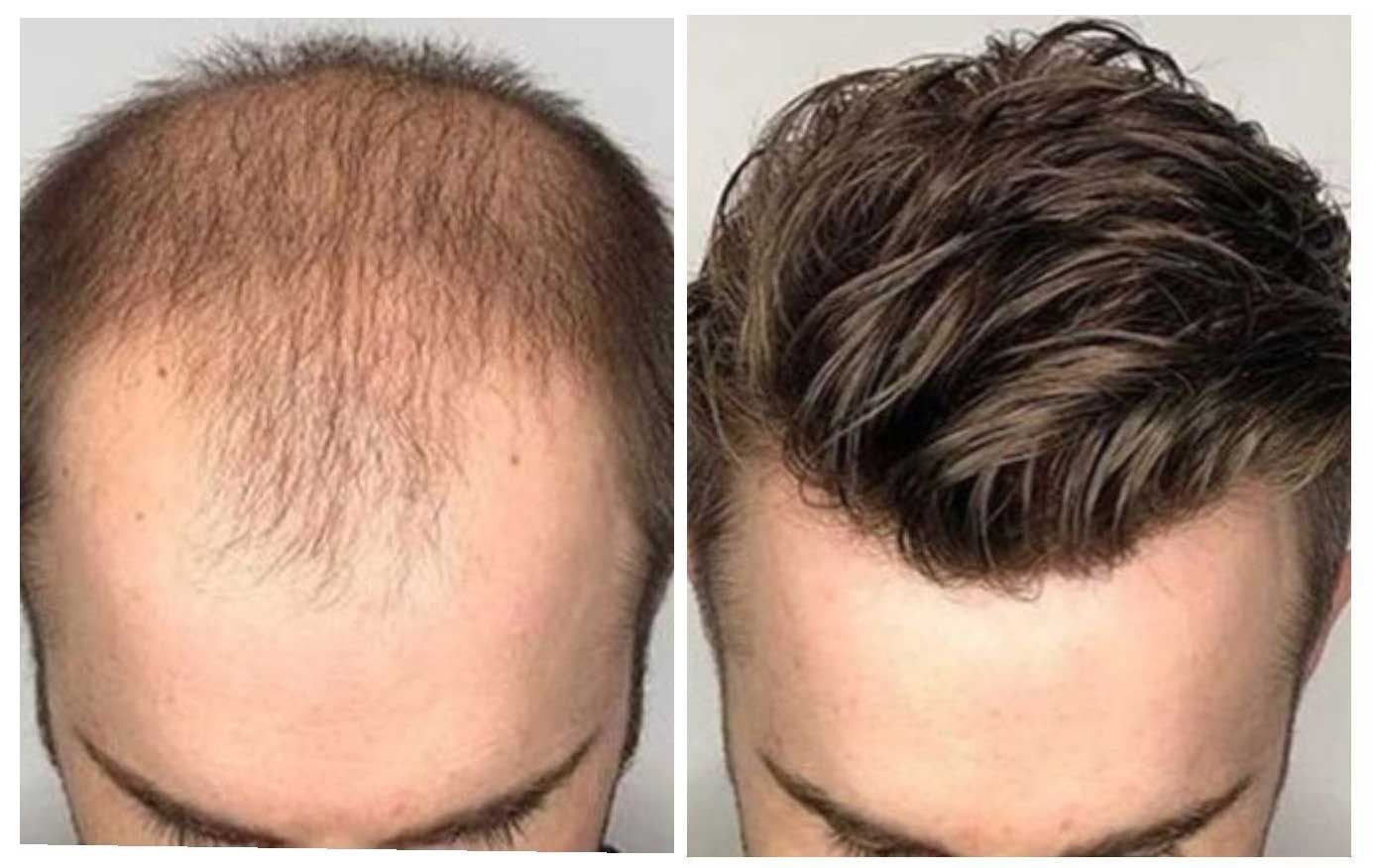 A before and after comparison of hair regrowth, showing sparse hair on the left and full, styled hair on the right.