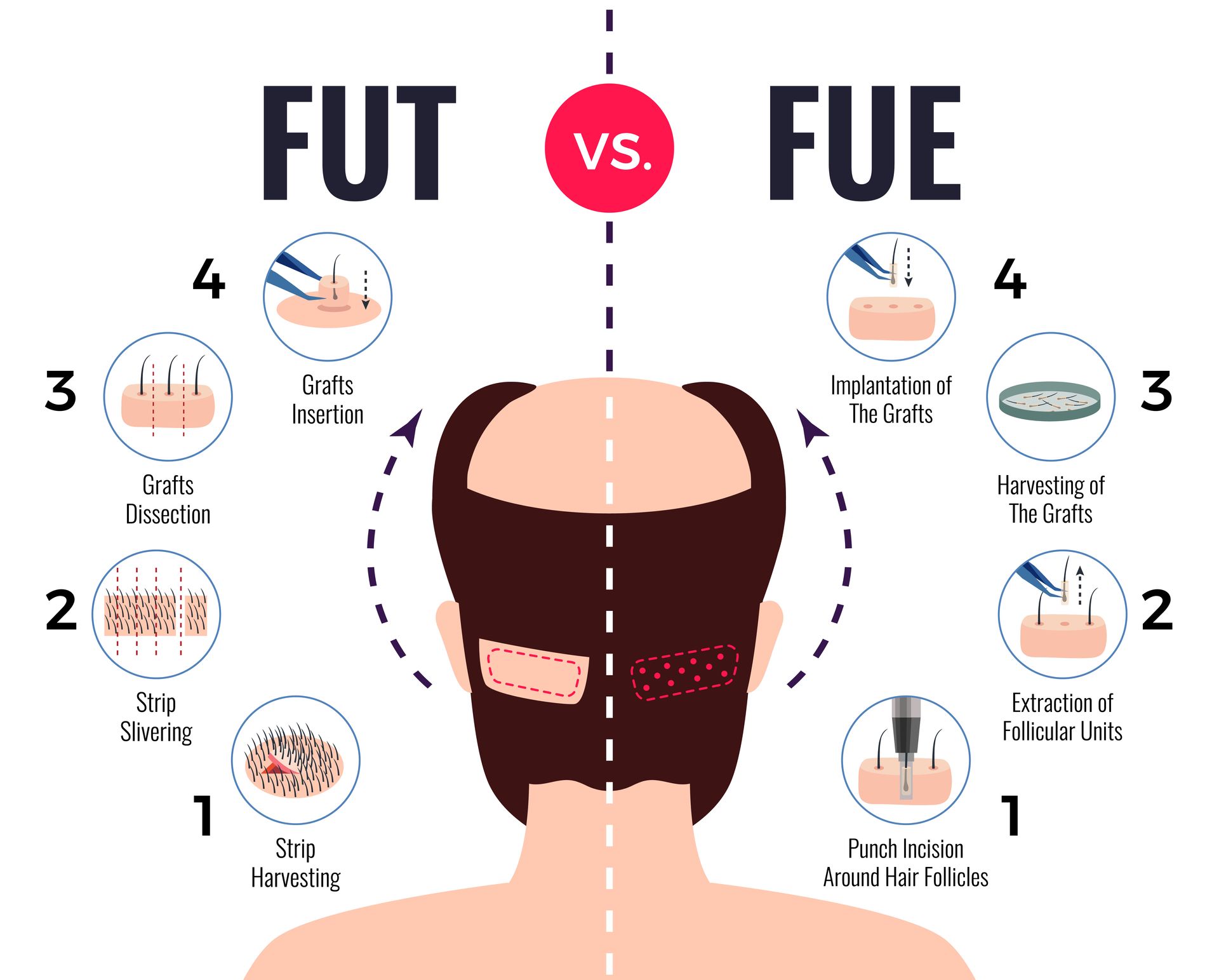 An infographic comparing FUT and FUE hair transplant methods, showing donor area harvesting steps for each procedure.