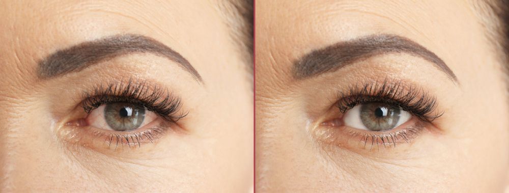 Side-by-side comparison of an eye showing reduced wrinkles and smoother skin around the under-eye area.