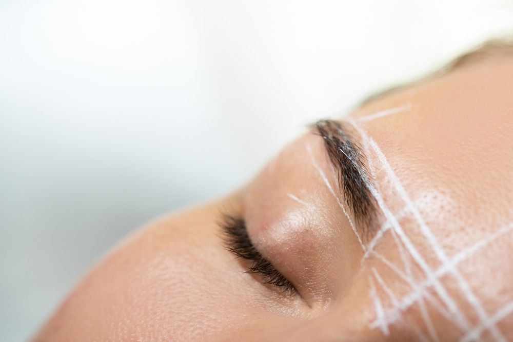 Close-up of a person's eyebrow area with white mapping lines drawn on the skin for a cosmetic procedure.
