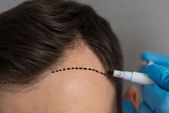 A person in blue medical gloves uses a marker to draw a dotted hairline guide on a person's forehead.