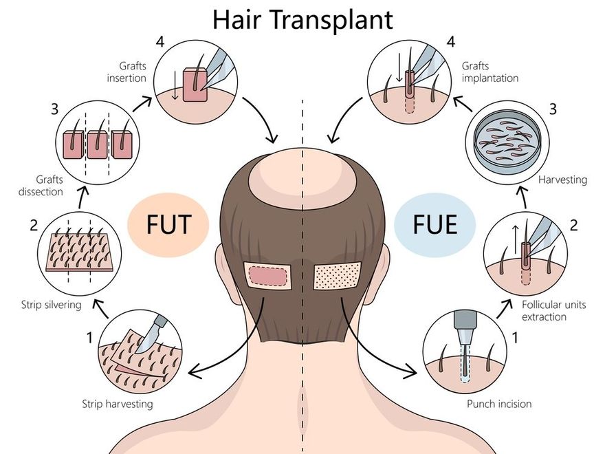 Infographic comparing FUT and FUE hair transplant methods