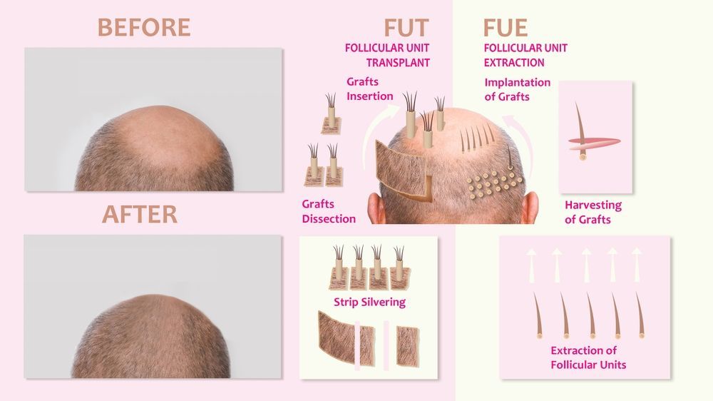 An educational infographic comparing FUT and FUE hair transplant methods
