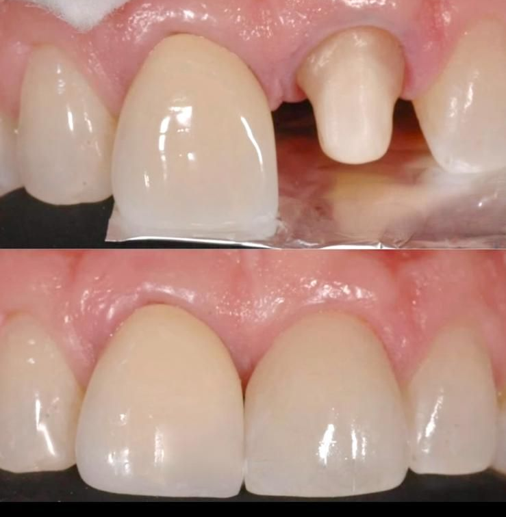 Faccette dentali in ceramica o composito: sottili rivestimenti che correggono forma, colore e posizione dei denti, donando un sorriso perfetto.