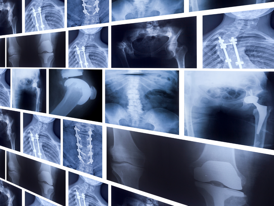 A collage of various blue-toned medical X-rays showing orthopedic implants, hardware, and joint replacements.