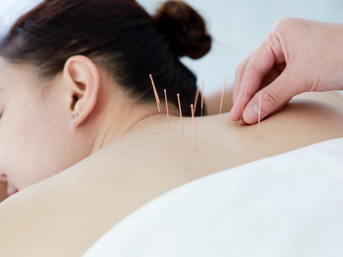 A practitioner places acupuncture needles into a patient's back while the patient lies face down.