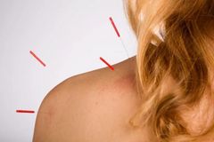 A shoulder receiving acupuncture treatment with several thin needles inserted into the skin.