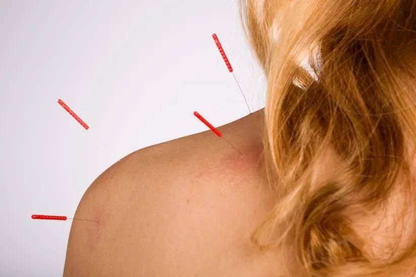 A person receives acupuncture with needles inserted into the skin on their shoulder.