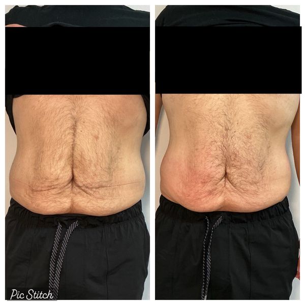 T-Shape 2 abdominal skin tightening and body contouring before and after