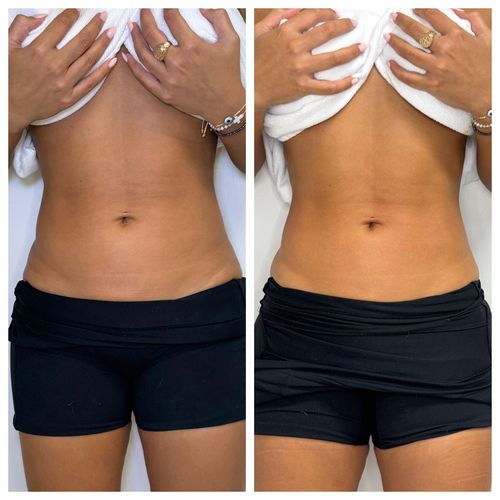 Before and after skin tightening results.