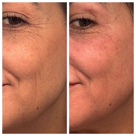 T-Shape 2: Before-and-after skin-tightening results.
