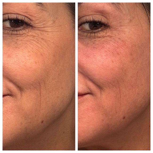 Before and after skin tightening results.
