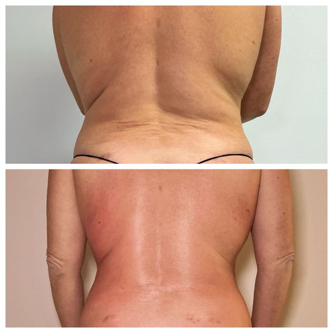 T-Shape 2 before and after back and flank contouring
