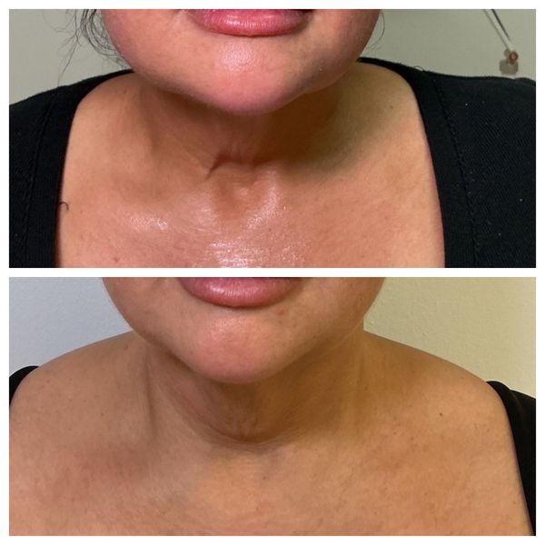 T-Shape 2 jawline contouring before and after