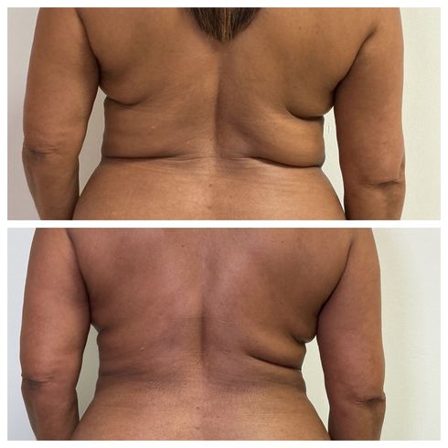 T-Shape 2: Before and after skin tightening results.