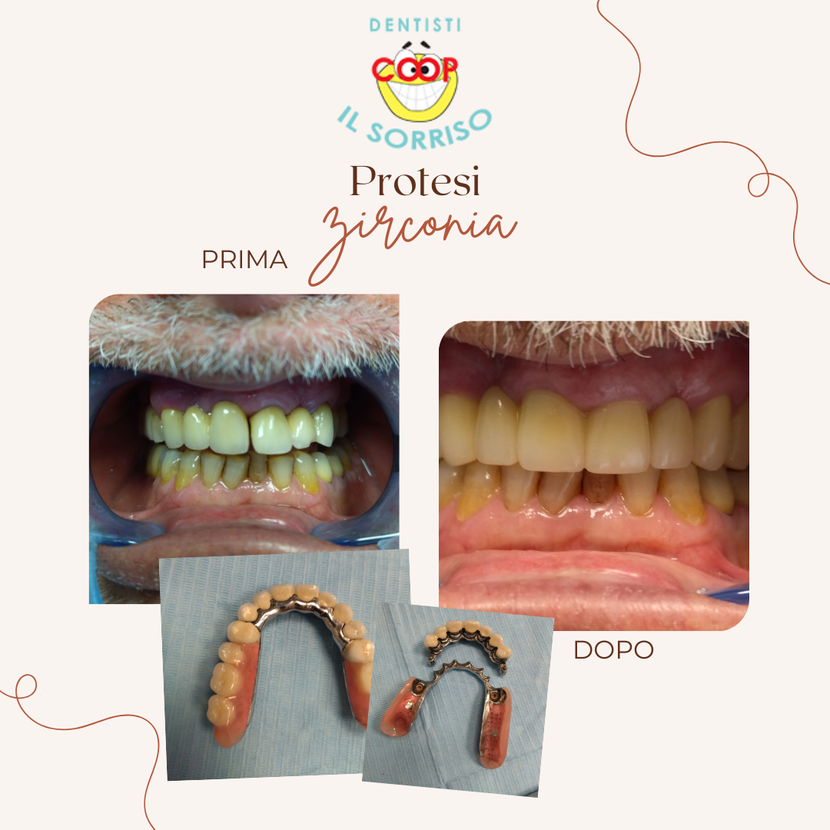 Paziente sorridente con mascherina ortodontica trasparente