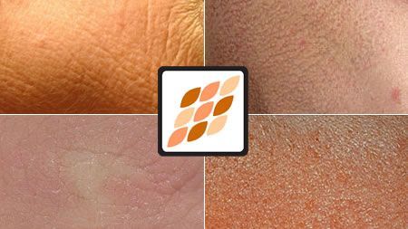 A collage of four pictures of different types of skin.