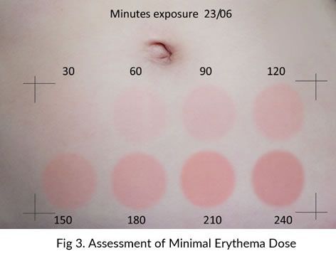 Fig 3 assessment of minimal erythema dose is shown