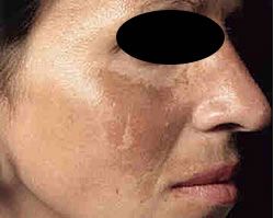A close up of a woman 's face with a black circle around her eyes.