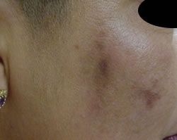 A close up of a woman 's face with a bruise on it.