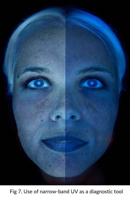 A woman 's face is shown before and after using narrow-band uv as a diagnostic tool
