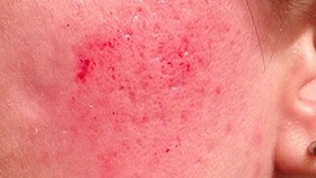 A close up of a person 's face with red spots on it.