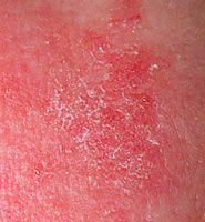 A close up of a red rash on a person 's face.
